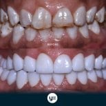 Resultado antes y después de implantes dentales All-on-4 en YeahSmile – sonrisa restaurada