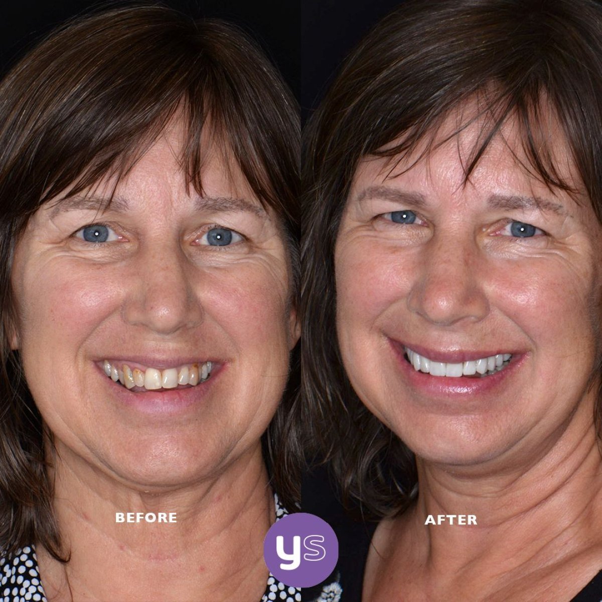 Resultados antes y después de coronas dentales en YeahSmile, mejora estética de la sonrisa
