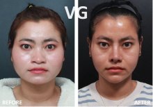 Blepharoplastik Vorher-Nachher-Ergebnisse bei VG Plastic Surgery, Lidkorrektur