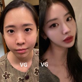 Vorher-nachher-Ergebnis der Blepharoplastik bei VG Plastic Surgery, Lidkorrektur