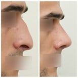 نتائج تجميل الأنف قبل وبعد في عيادة وونجين، تحسين شكل الأنف الجانبي