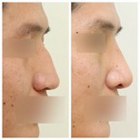 نتائج تجميل الأنف قبل وبعد في عيادة وونجين، تحسين شكل الأنف الجانبي
