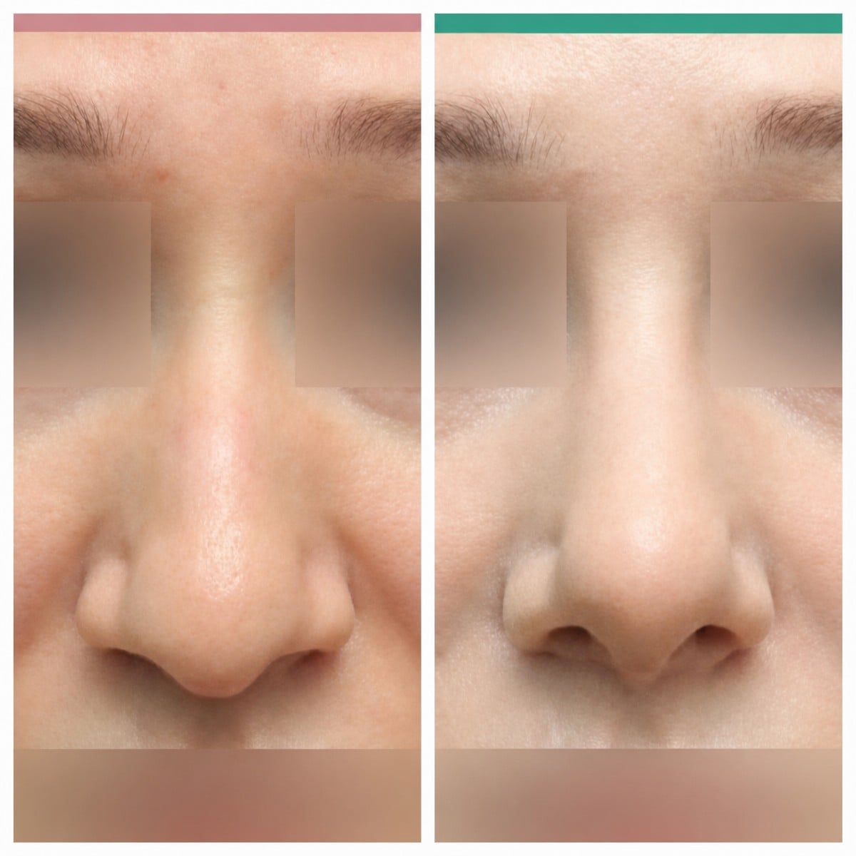 Resultados de rinoplastia antes y después en Wonjin Plastic Surgery Clinic, remodelación nasal
