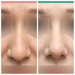 نتائج تجميل الأنف قبل وبعد في عيادة وونجين لجراحة التجميل، إعادة تشكيل الأنف