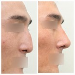 نتائج عملية تجميل الأنف قبل وبعد في عيادة وونجين، تحسين شكل الأنف الجانبي