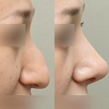 نتائج تجميل الأنف قبل وبعد في عيادة وونجين، تحسين شكل الأنف الجانبي