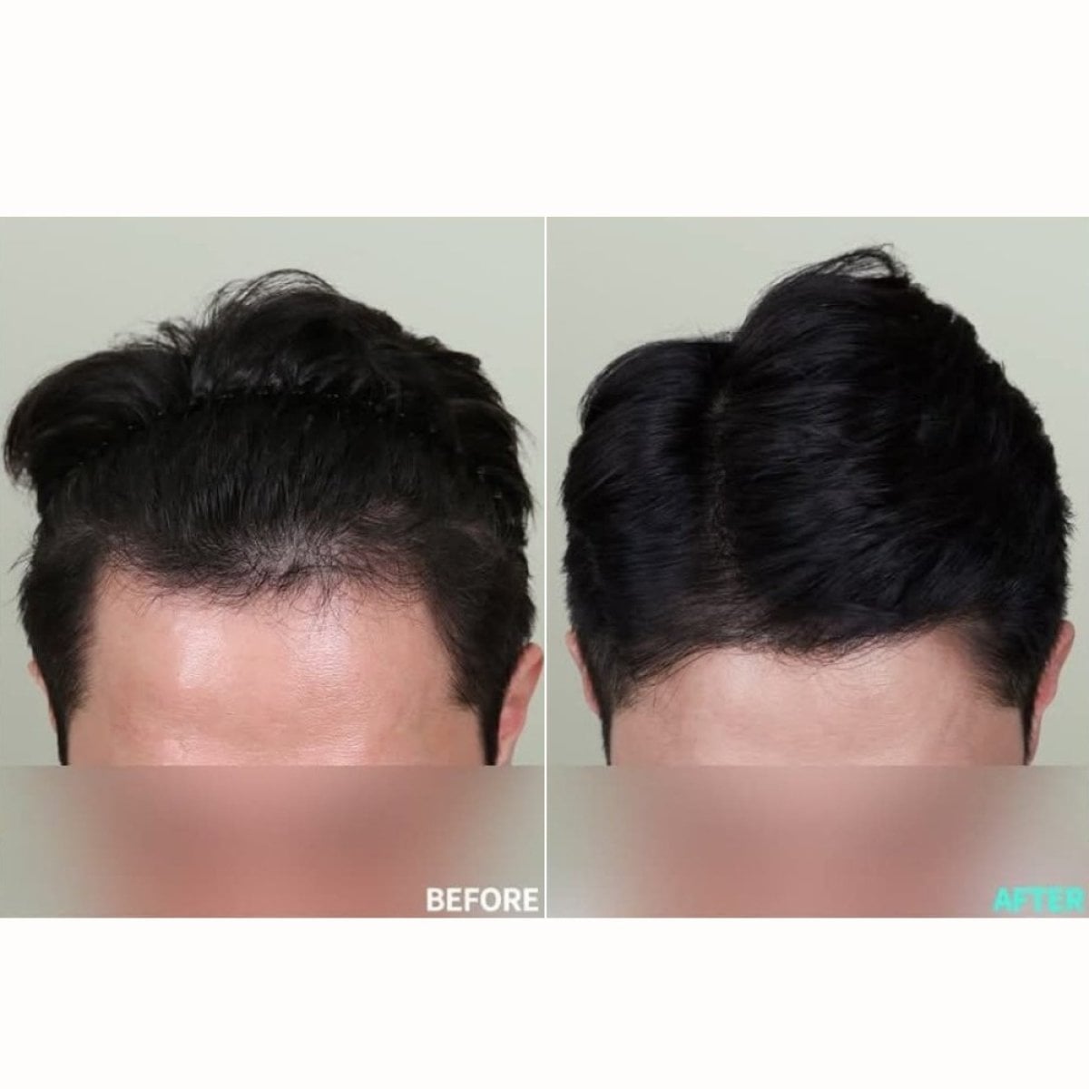 Resultados de trasplante capilar antes y después en Wonjin, línea de cabello mejorada