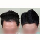 نتائج زراعة الشعر قبل وبعد في عيادة وونجين، خط شعر محسّن