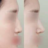 نتائج تجميل الأنف قبل وبعد في عيادة وونجين، إعادة تشكيل الأنف