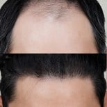 نتائج زراعة الشعر قبل وبعد في عيادة وونجين، استعادة خط الشعر الأمامي