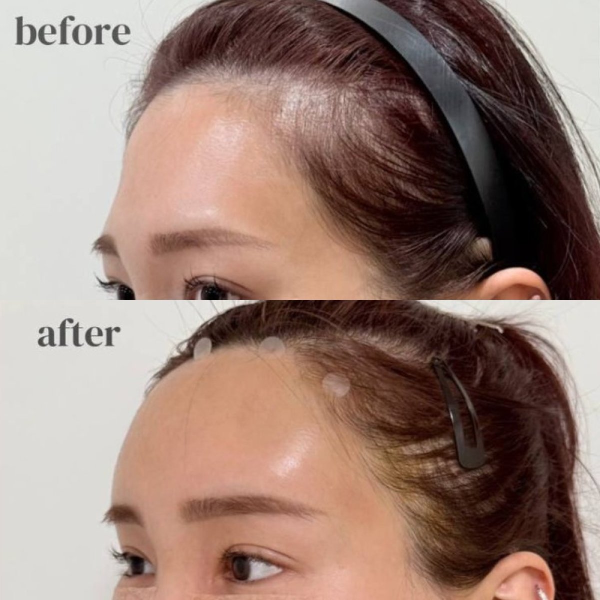 Antes y después de lipofilling de frente en Wonjin Plastic Surgery Clinic, resultado visible