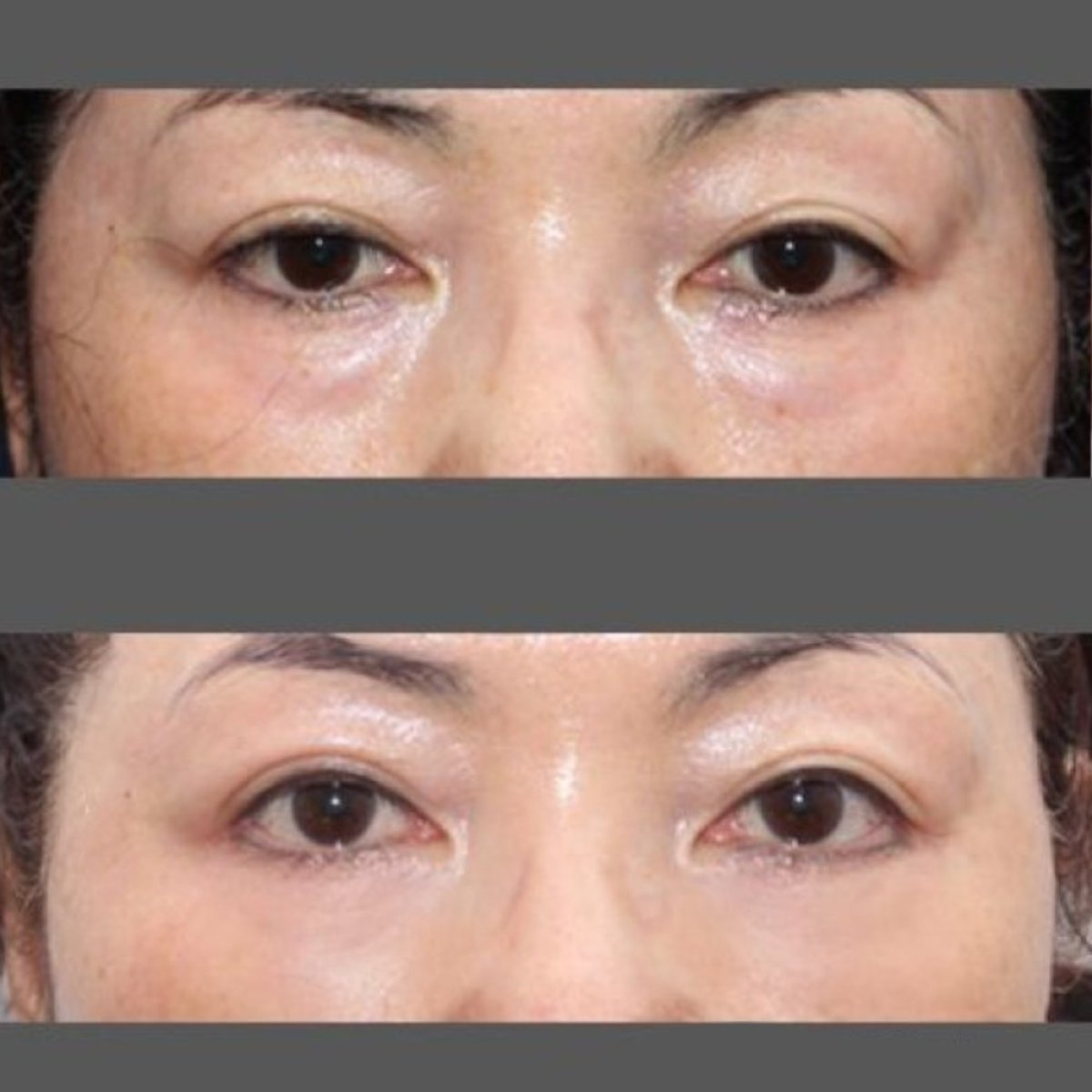 نتائج شد الجفن السفلي قبل وبعد في HERSHE Plastic Surgery Korea