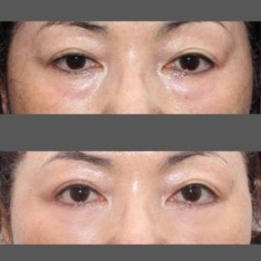 Результаты блефаропластики нижних век до и после в HERSHE Plastic Surgery Korea
