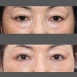 Результаты блефаропластики нижних век до и после в HERSHE Plastic Surgery Korea