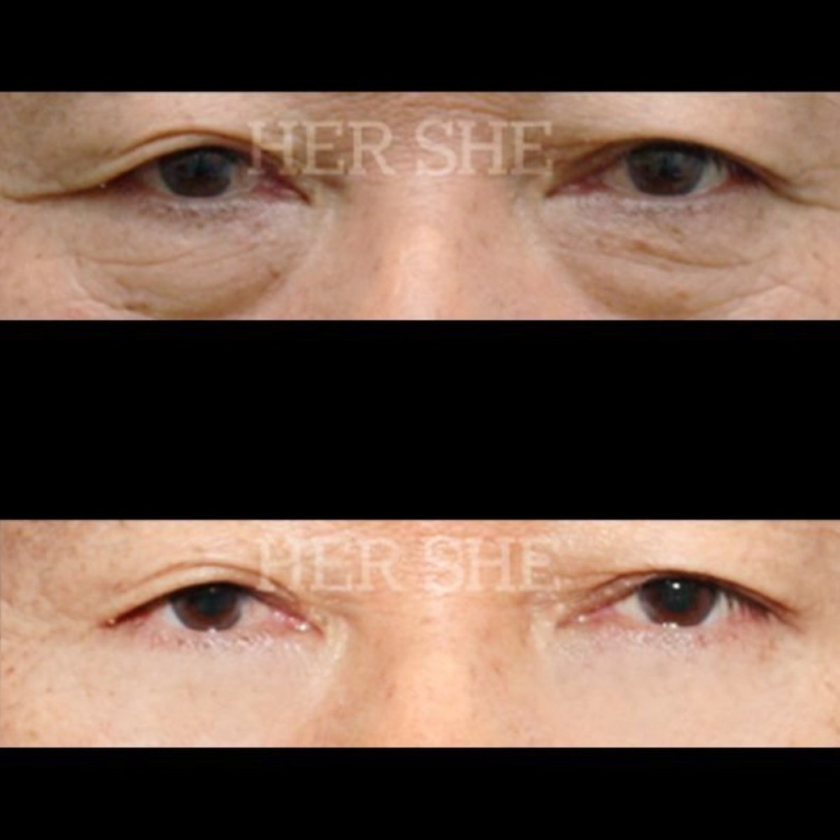 نتائج شد الجفن السفلي قبل وبعد في HERSHE Plastic Surgery Korea