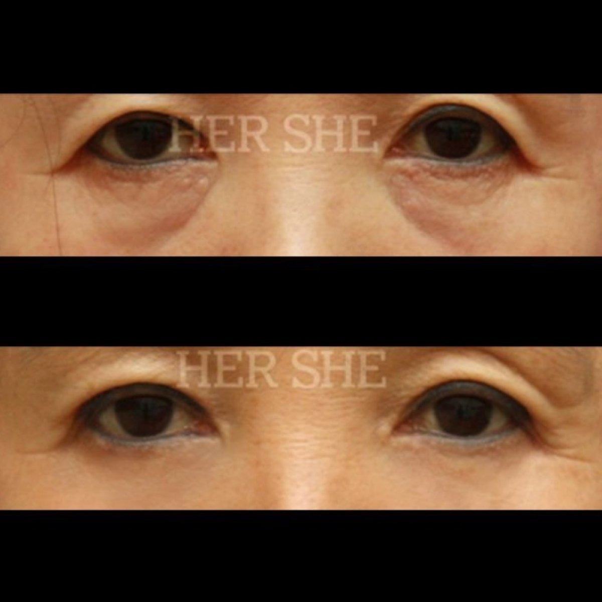 نتائج شد الجفن السفلي قبل وبعد في عيادة HERSHE لجراحة التجميل كوريا