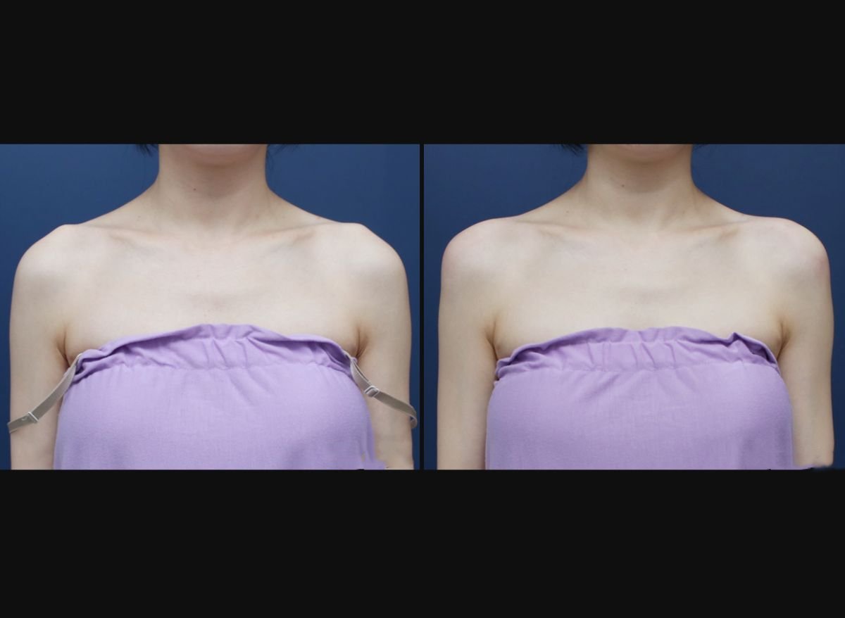 Antes y después de rellenos de ácido hialurónico en hombros en HERSHE Plastic Surgery Korea