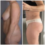 نتائج شد البطن والشفط قبل وبعد في Yurchenko Plastic Surgery Team Kyiv