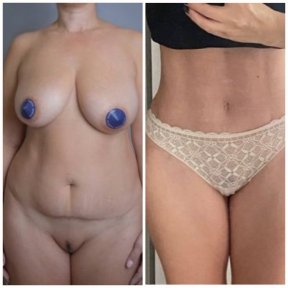 نتائج شد البطن والشفط قبل وبعد في Yurchenko Plastic Surgery Team Kyiv