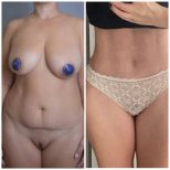 نتائج شد البطن والشفط قبل وبعد في Yurchenko Plastic Surgery Team Kyiv