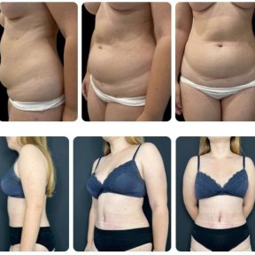 نتائج شد البطن والشفط قبل وبعد في Yurchenko Plastic Surgery Team Kyiv
