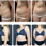 نتائج شد البطن والشفط قبل وبعد في Yurchenko Plastic Surgery Team Kyiv