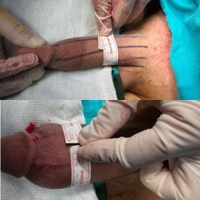 Vorher-nachher-Ergebnisse der Penisimplantat-OP bei Uroaesthetic, sichtbare Umfangsverbesserung