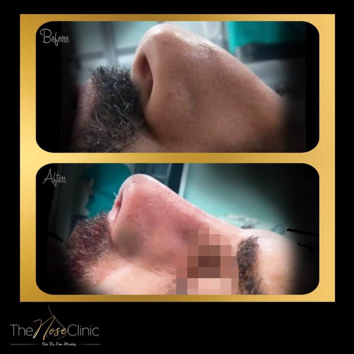 Vorher-nachher-Ergebnis der Revision-Rhinoplastik in The Nose Clinic, verbesserte Nasenform