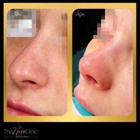 Before and after revision rhinoplasty results at The Nose Clinic, improved nose shape
