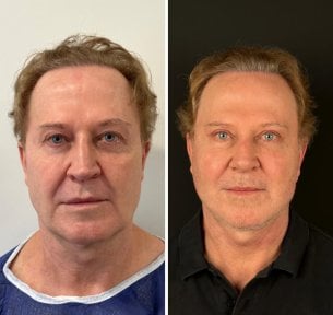 Before and after neck lift results at Dr. Safa Manav Clinic, visible neck and jawline improvement