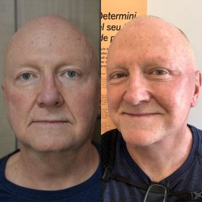 Vorher-nachher-Ergebnis Halslifting bei Dr. Safa Manav Clinic, sichtbare Verjüngung