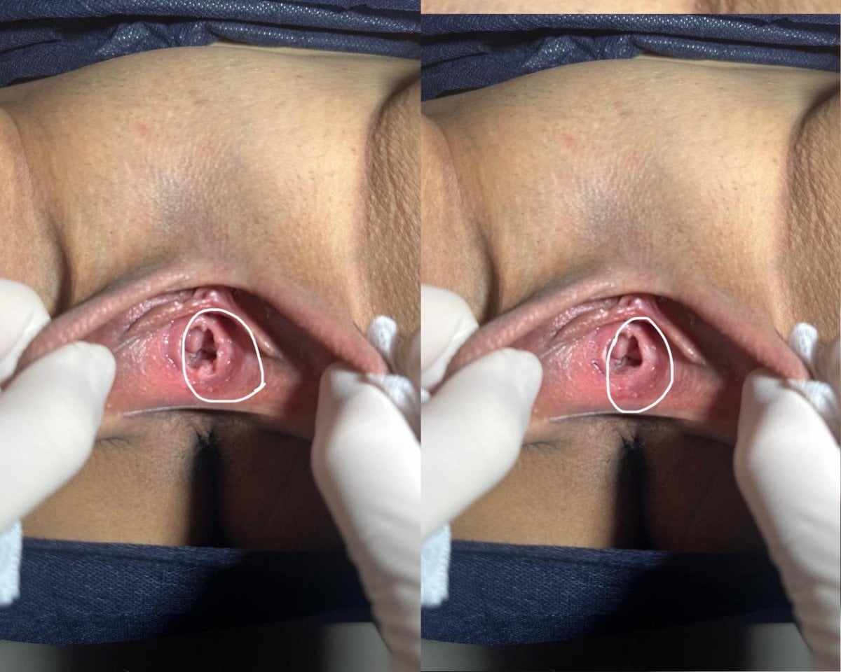 Resultados antes y después de himenoplastia en Dr. İrem Yengel Clinic, restauración del himen