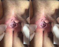 Vorher-nachher-Ergebnisse der Hymenoplastik in der Dr. İrem Yengel Klinik, Hymenrekonstruktion