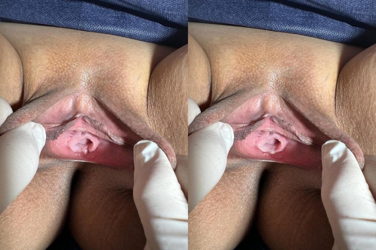 Resultados de antes y después de himenoplastia en Dr. İrem Yengel Clinic, restauración de himen