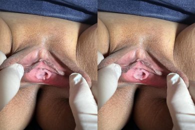 Vorher-nachher-Ergebnisse der Hymenoplastik in der Dr. İrem Yengel Klinik, Hymenrekonstruktion