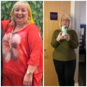 Vorher-nachher-Ergebnisse Roux-en-Y-Magenbypass in Dr. Islam Abdelkhaleks Klinik