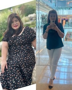 Before and after Roux-en-Y gastric bypass results at Dr. Islam Abdelkhalek's Clinic, weight loss