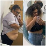 Vorher-nachher-Ergebnis Roux-en-Y-Magenbypass bei Dr. Islam Abdelkhalek's Clinic