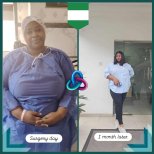 До та після Roux-en-Y шунтування у клініці доктора Іслама Абдельхалека, результат