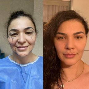 Vorher-nachher-Ergebnis der Blepharoplastik in der Dr. Safa Manav Klinik, Lidkorrektur