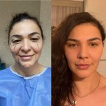 Vorher-nachher-Ergebnis der Blepharoplastik in der Dr. Safa Manav Klinik, Lidkorrektur