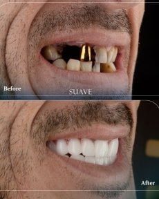 Resultados antes y después de implantes All-on-4 en SUAVE DENTAL CLINIC, sonrisa restaurada