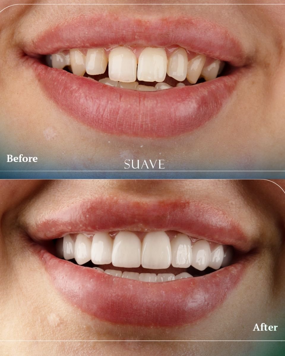 Antes y después de carillas en SUAVE DENTAL CLINIC: sonrisa renovada y natural