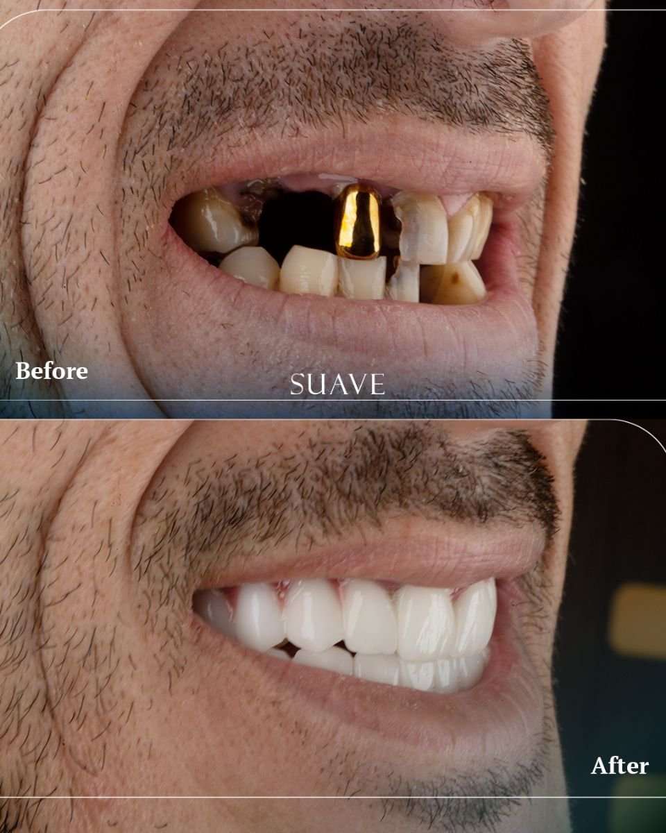 Resultados antes y después de implantes All-on-6 en SUAVE DENTAL CLINIC, restauración de sonrisa