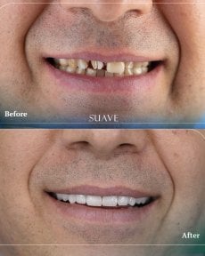 Before and after dental crown installation results at SUAVE DENTAL CLINIC, improved smile