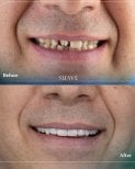 Before and after dental crown installation results at SUAVE DENTAL CLINIC, improved smile