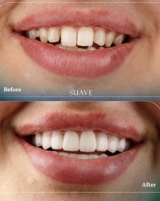 Before and after dental crown installation results at SUAVE DENTAL CLINIC, smile transformation