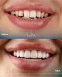 Before and after dental crown installation results at SUAVE DENTAL CLINIC, smile transformation