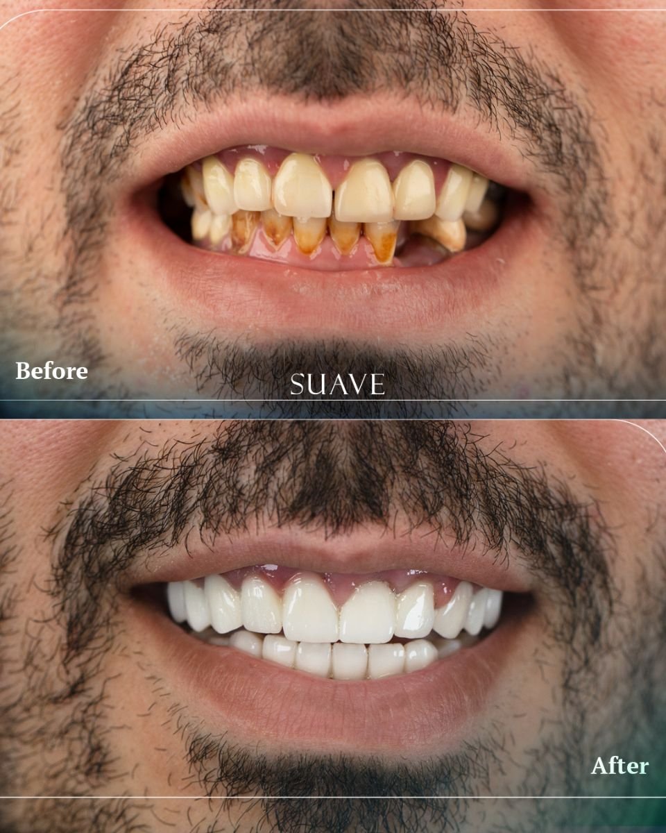 Результати до та після встановлення коронок у SUAVE DENTAL CLINIC, відновлення посмішки