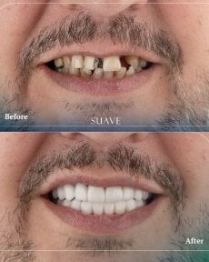 Before and after dental crown installation results at SUAVE DENTAL CLINIC, smile restoration